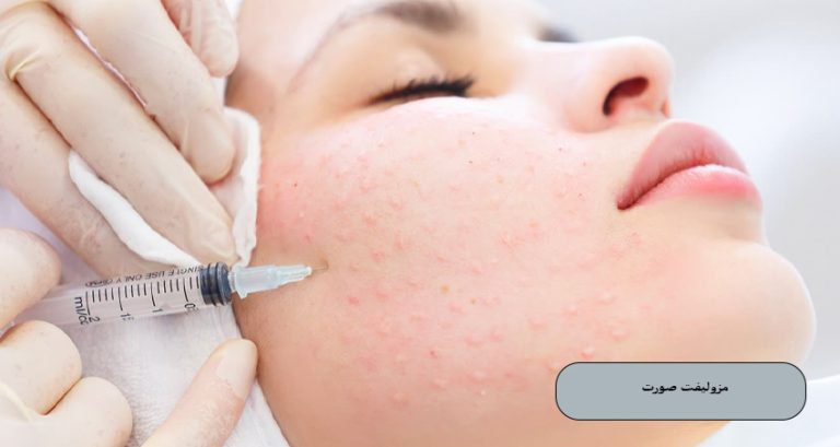 مزولیفت صورت