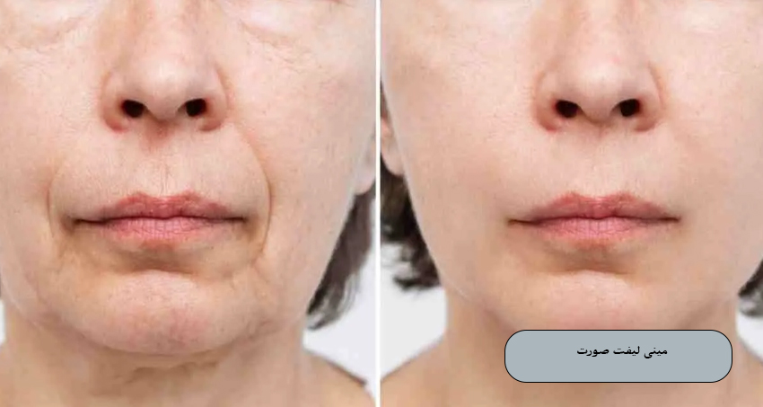 مینی لیفت صورت چیست؟