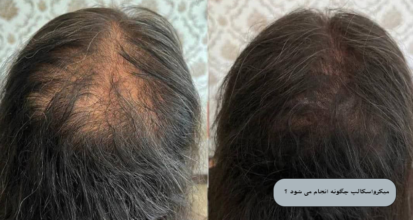 میکرواسکالپ چگونه انجام می ‌شود ؟