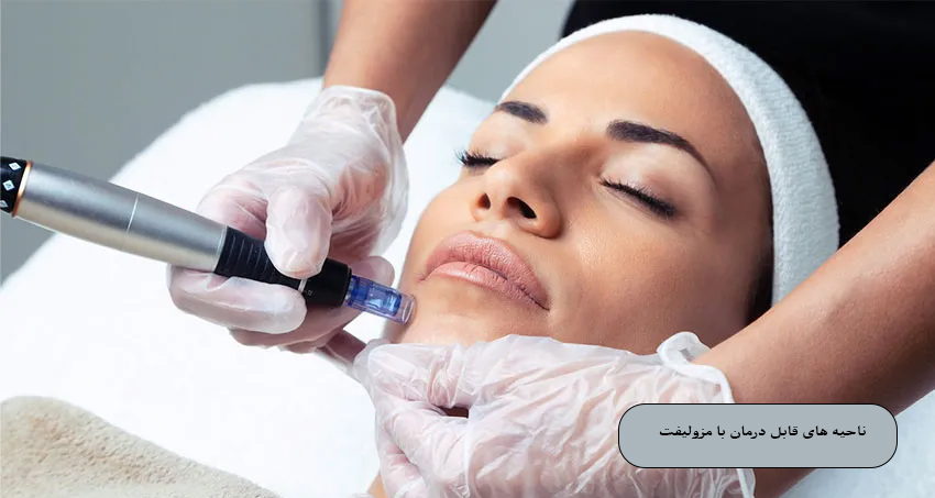 ناحیه‌ های قابل درمان با مزولیفت صورت