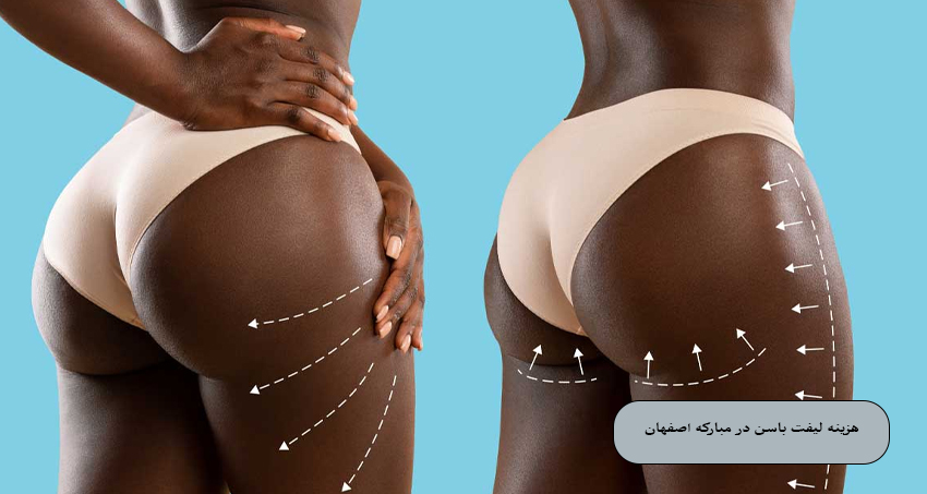 هزینه لیفت باسن در مبارکه اصفهان