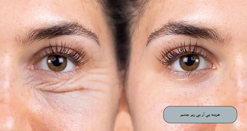 هزینه پی آر پی زیر چشم