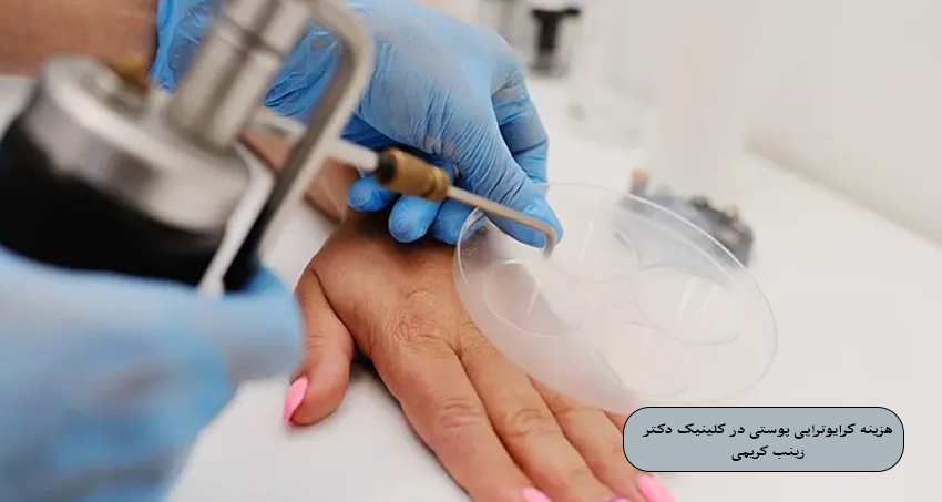 هزینه کرایوتراپی پوستی