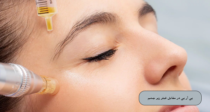 پی آر پی در مقابل فیلر زیر چشم