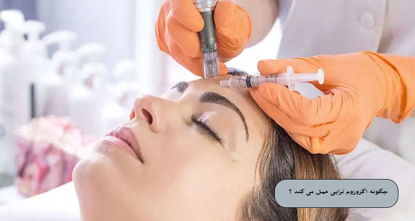 چگونه اگزوزوم‌ تراپی عمل می‌ کند؟