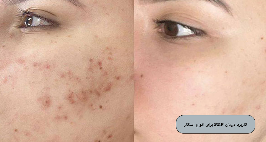 کاربرد درمان PRP برای انواع اسکار