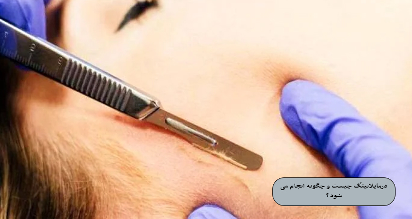 درماپلنینگ چیست