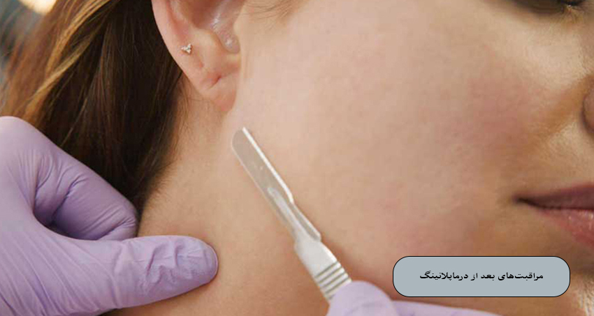 مراقبت‌های بعد از درما پلنینگ