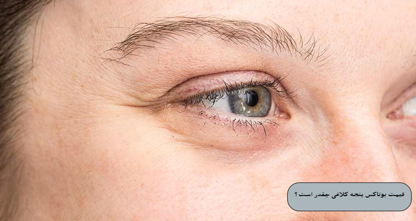 قیمت بوتاکس پنجه کلاغی