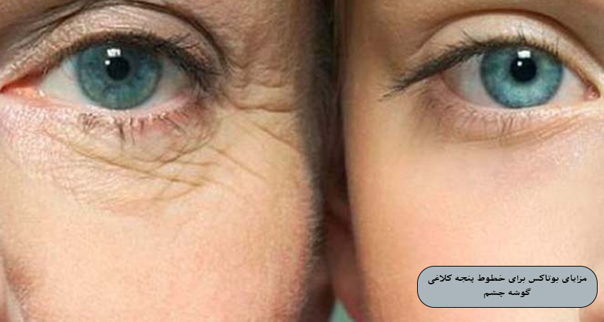 مزایای بوتاکس برای خطوط پنجه کلاغی