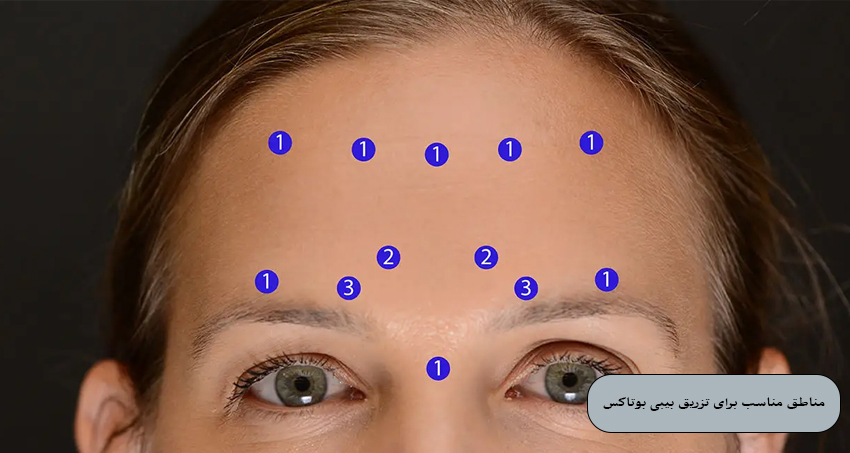 مناطق مناسب برای تزریق بیبی بوتاکس